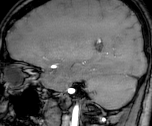 Cerebral arteriovenous malformation at posterior body of corpus callosum (Radiopaedia 74111-84925 J 117).jpg