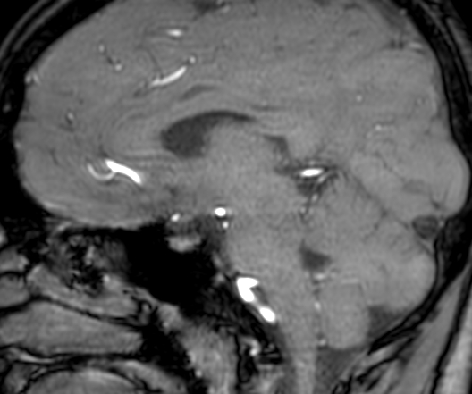 Cerebral arteriovenous malformation at posterior body of corpus callosum (Radiopaedia 74111-84925 J 209).jpg