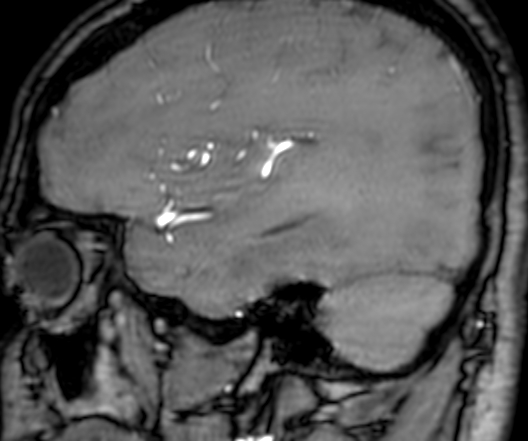 Cerebral arteriovenous malformation at posterior body of corpus callosum (Radiopaedia 74111-84925 J 80).jpg