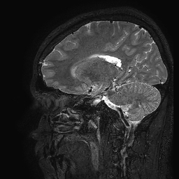 Cerebral arteriovenous malformation at posterior body of corpus callosum (Radiopaedia 74111-84925 Sagittal T2 49).jpg
