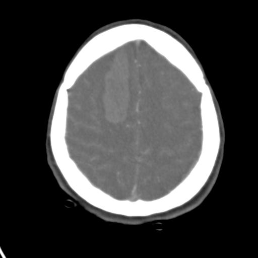 Cerebral arteriovenous malformation with hemorrhage (Radiopaedia 28773-29073 A 13).jpg