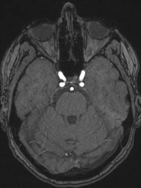 Cerebral arteriovenous malformation with hemorrhage (Radiopaedia 34422-35737 Axial MRA 25).png
