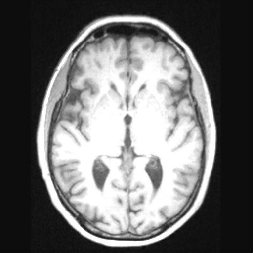 Cerebral arteriovenous malformation with hemorrhage (Radiopaedia 34422-35737 Axial T1 39).png