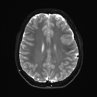 Cerebral cavernous venous malformation (Radiopaedia 70008-80021 Axial DWI 21).jpg