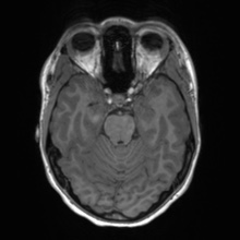 File:Cerebral cavernous venous malformation (Radiopaedia 70008-80021 Axial T1 24).jpg
