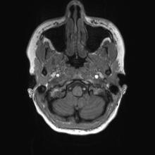 Cerebral cavernous venous malformation (Radiopaedia 70008-80021 Axial T1 5).jpg