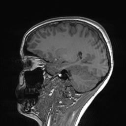 File:Cerebral cavernous venous malformation (Radiopaedia 70008-80021 Sagittal T1 49).jpg
