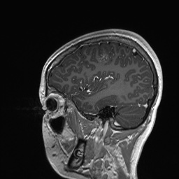 Cerebral cavernous venous malformation (Radiopaedia 70008-80021 Sagittal T1 C+ 17).jpg