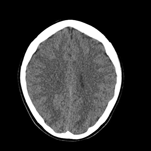 File:Cerebral cavernous venous malformation (Radiopaedia 70008-80022 Axial non-contrast 34).jpg