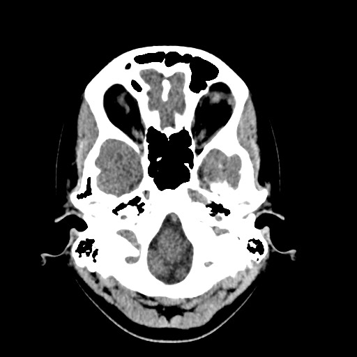 Cerebral cavernous venous malformation (Radiopaedia 70008-80022 Axial non-contrast 6).jpg