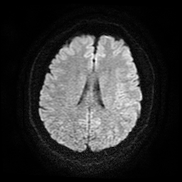 File:Cerebral cavernous venous malformation (Zabramski type II) (Radiopaedia 85511-101198 Axial DWI 53).jpg