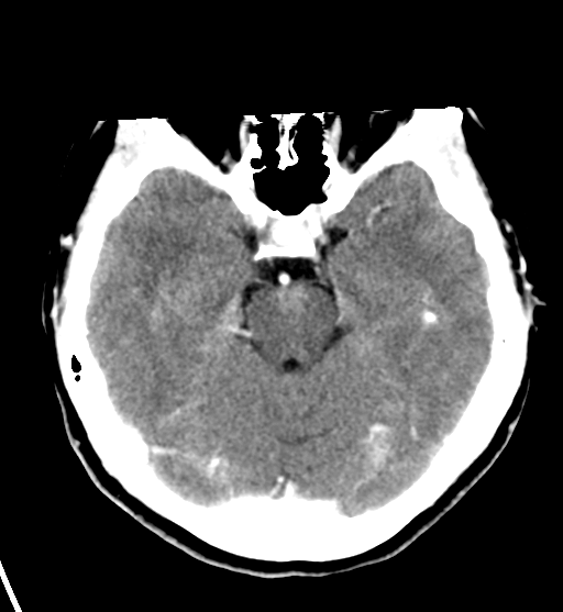 File:Cerebral cavernous venous malformations (Radiopaedia 48117-52945 Axial C+ delayed 13).png