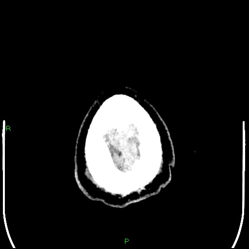 Cerebral contusions (Radiopaedia 33868-35039 Axial non-contrast 213).jpg