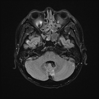 File:Cerebral embolic infarcts (embolic shower) (Radiopaedia 72391-82921 Axial FLAIR 8).jpg