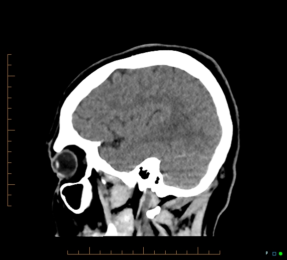 Cerebral fat embolism (Radiopaedia 85521-101220 B 41).jpg