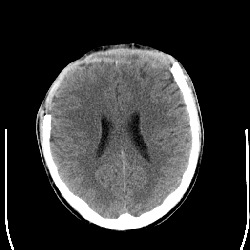 File:Cerebral hemorrhagic contusions- temporal evolution (Radiopaedia 40224-42756 Axial non-contrast 17).png