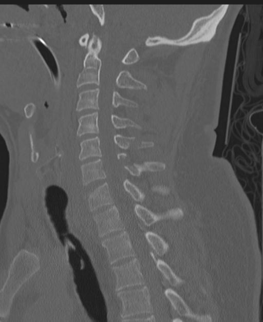 Cerebral hemorrhagic contusions and cervical spine fractures (Radiopaedia 32865-33841 Sagittal bone window 55).jpg