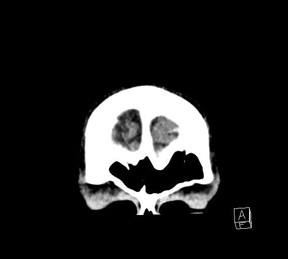 Cerebral metastases - testicular choriocarcinoma (Radiopaedia 84486-99855 D 6).jpg