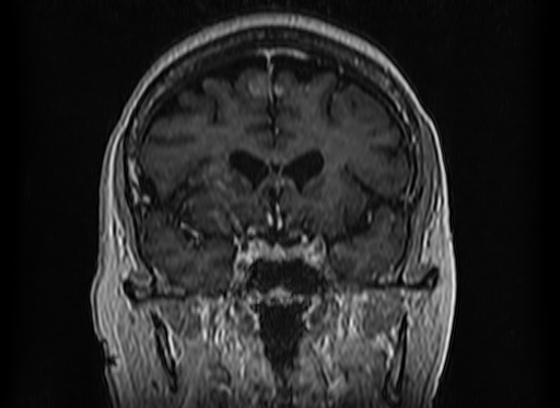 Cerebral metastases from lung cancer with amyloid angiopathy and cerebellopontine angle meningioma (Radiopaedia 74306-85191 Coronal T1 C+ 21).jpg