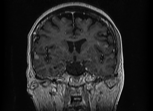 File:Cerebral metastases from lung cancer with amyloid angiopathy and cerebellopontine angle meningioma (Radiopaedia 74306-85191 Coronal T1 C+ 26).jpg