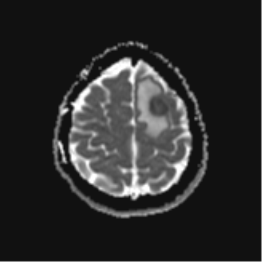 File:Cerebral metastases mimicking abscesses (Radiopaedia 45841-50131 Axial ADC 24).png