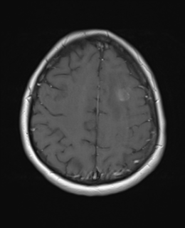 File:Cerebral metastases mimicking abscesses (Radiopaedia 45841-50131 Axial T1 C+ fat sat 22).png