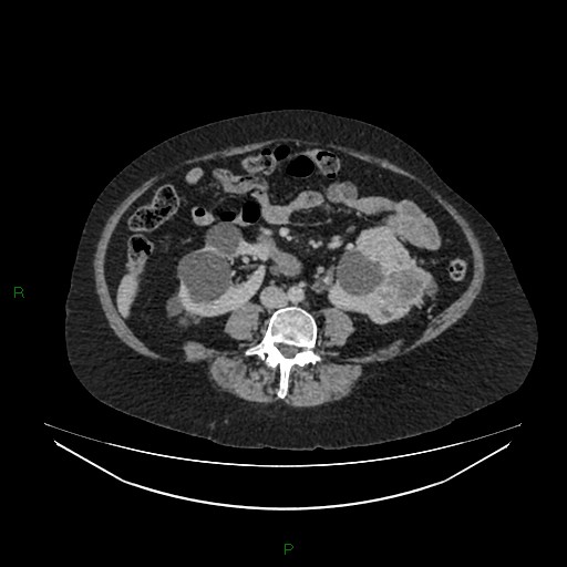 File:Cerebral metastasis from renal cell carcinoma (Radiopaedia 82306-96378 A 103).jpg