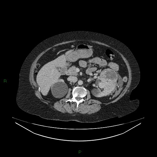 Cerebral metastasis from renal cell carcinoma (Radiopaedia 82306-96378 A 70).jpg
