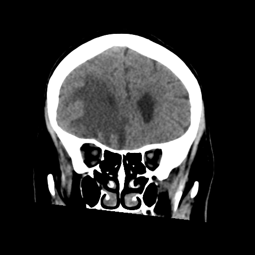 Cerebral metastasis to basal ganglia (Radiopaedia 81568-95412 Coronal non-contrast 23).png