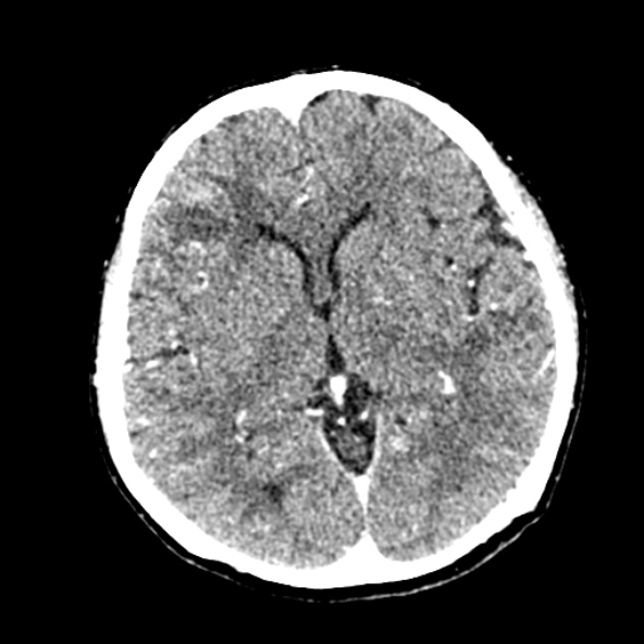 File:Cerebral ring enhancing lesions - cerebral metastases (Radiopaedia 44922-48818 B 144).jpg