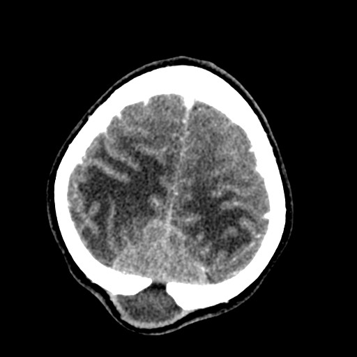 Cerebral tuberculosis with dural sinus invasion (Radiopaedia 60353-68019 Axial C+ delayed 56).jpg