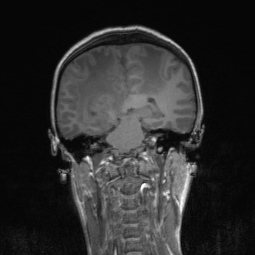 Cerebral tuberculosis with dural sinus invasion (Radiopaedia 60353-68090 Coronal T1 114).jpg