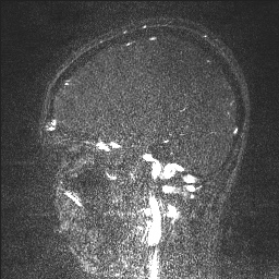 Cerebral tuberculosis with dural sinus invasion (Radiopaedia 60353-68090 Sagittal MRV 104).jpg