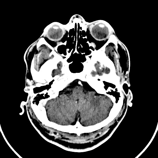 Cerebral venous angioma (Radiopaedia 69959-79977 B 3).jpg
