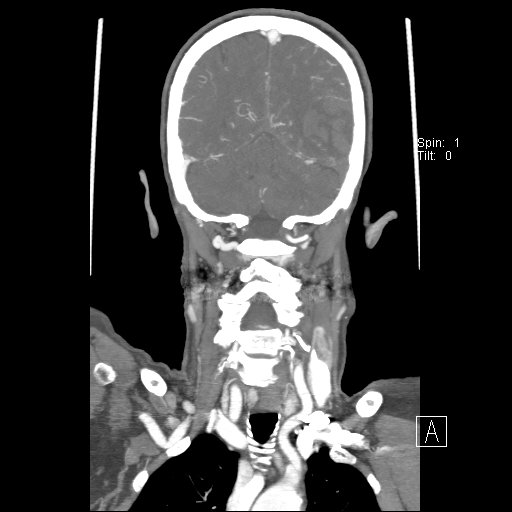 Cerebral venous infarction with hemorrhage (Radiopaedia 65343-74396 B 206).jpg