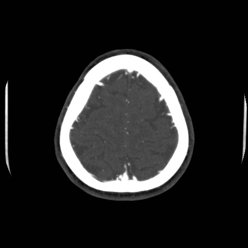 Cerebral venous sinus thrombosis (Radiopaedia 40619-43227 A 199).jpg