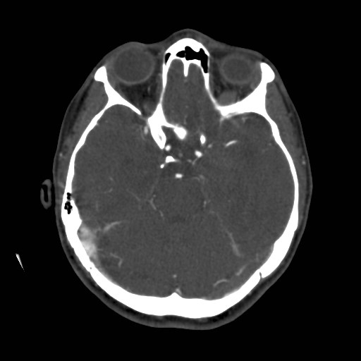 Cerebral venous sinus thrombosis (Radiopaedia 40619-43227 A 80).jpg