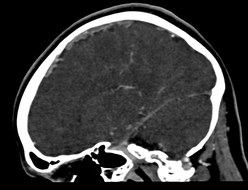 Cerebral venous sinus thrombosis (Radiopaedia 59224-66646 Sagittal C+ delayed 15).jpg