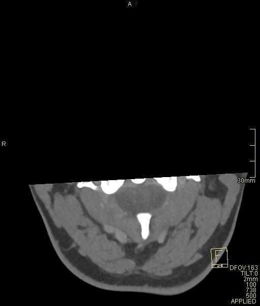 Cerebral venous sinus thrombosis (Radiopaedia 91329-108965 Axial venogram 1).jpg
