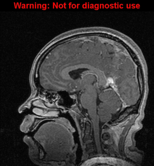 Cerebral venous thrombosis (Radiopaedia 37224-39208 Sagittal T1 C+ 79).jpg