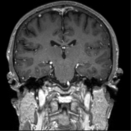 Cerebral venous thrombosis (Radiopaedia 38392-40469 Coronal T1 C+ 41).png