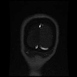 Cerebral venous thrombosis - ulcerative colitis (Radiopaedia 66049-75219 Coronal MRV 12).jpg