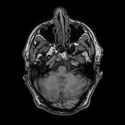 File:Cerebral venous thrombosis with secondary intracranial hypertension (Radiopaedia 89842-106957 Axial T1 54).jpg
