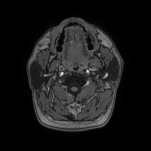 File:Cerebral venous thrombosis with secondary intracranial hypertension (Radiopaedia 89842-106957 Axial T1 C+ 11).jpg