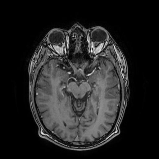 File:Cerebral venous thrombosis with secondary intracranial hypertension (Radiopaedia 89842-106957 Axial T1 C+ 83).jpg