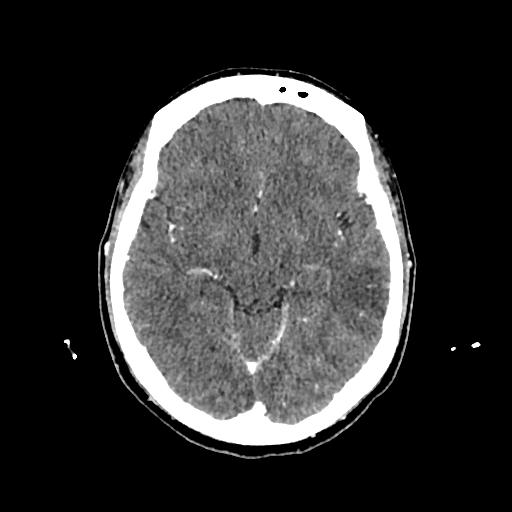 Cerebral venous thrombosis with venous hemorrhagic infarct (Radiopaedia 90354-107660 Axial with contrast 72).jpg