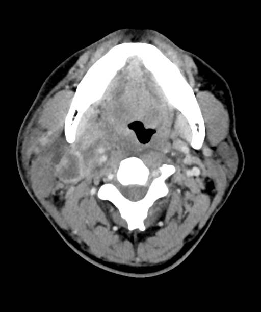 Cervical abscess (Radiopaedia 43725-47184 A 24).png