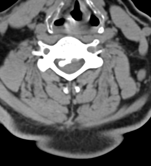 File:Cervical canal stenosis - OPLL and osteophytes (Radiopaedia 47329-51910 Axial non-contrast 35).png