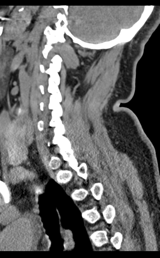 Cervical canal stenosis - OPLL and osteophytes (Radiopaedia 47329-51910 B 55).png