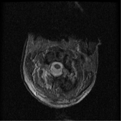 Cervical canal stenosis with cord compression (Radiopaedia 34114-35374 Axial Gradient Echo 90).png